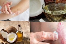 Skin Diseases Home Remedies: ২ তেলে মুক্তি চর্মরোগ থেকে! ঘরোয়া টোটকায় সারবে চামড়ার উপর দগদগে ফুসকুড়ি ও চুলকানি! গায়েব অস্বস্তি