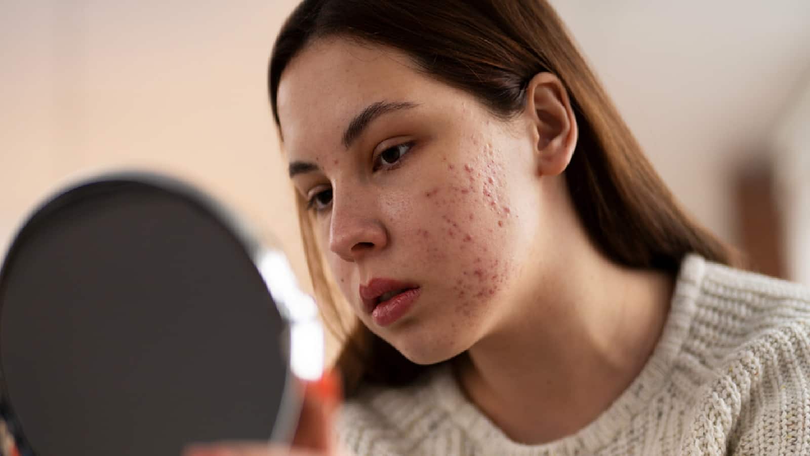 What Is Hormonal Acne: স্ট্রেস, চিনি ও দুধ! হরমোনাল অ্যাকনের নেপথ্যে বড় কারণগুলি কী কী? জানুন বিশেষজ্ঞের টিপস