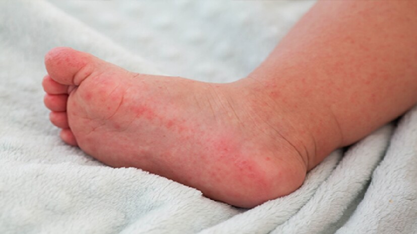 Heat Rash in Children: গরমে শিশুর সারা গায়ে দগদগে হিট র‍্যাশ? কীভাবে সমস্যার মোকাবিলা করবেন? পড়ুন