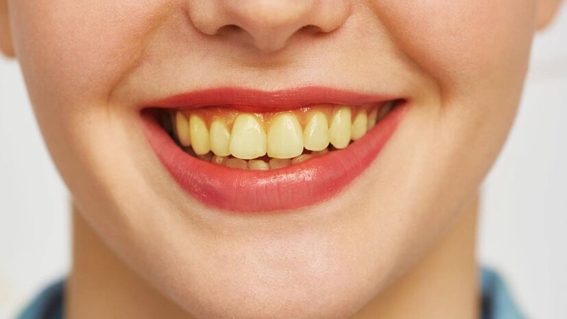 Yellow Teeth Remedies: ময়লার ঝুড়িতে না ফেলে এই খোসা ঘষুন দাঁতে ...