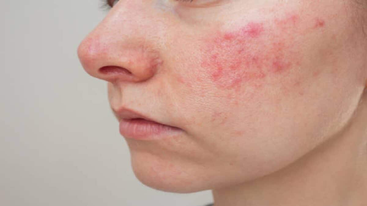 Skin Rash Remedy: অতিরিক্ত গরমে গোটা মুখে লাল লাল গুটি, কসমেটিক্স নয় ...