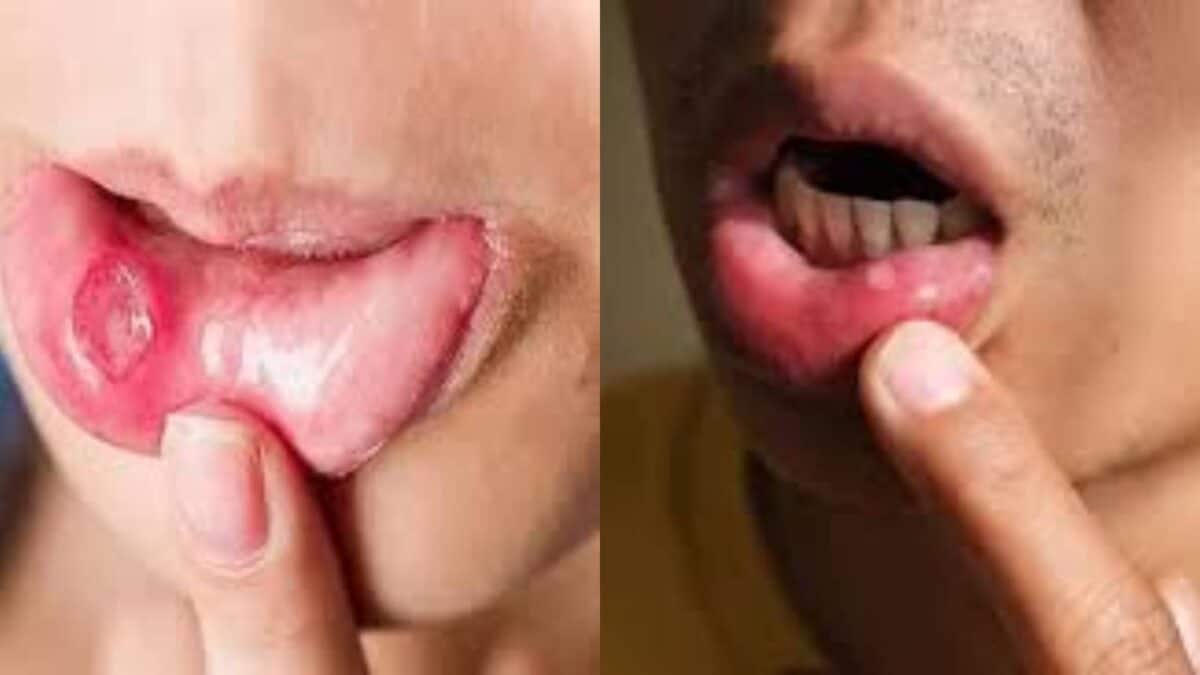 Mouth Ulcer & Oral Cancer: মাউথ আলসার থেকে কি ওরাল ক্যানসার হতে পারে? কখন বুঝবেন যে এই সংক্রমণ আতঙ্কের? জানুন বিশেষজ্ঞ কী বলছেন Mouth Ulcer & Oral Cancer: মাউথ আলসার থেকে কি ওরাল ক্যানসার হতে পারে? কখন বুঝবেন যে এই সংক্রমণ আতঙ্কের? জানুন বিশেষজ্ঞ কী বলছেন