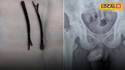 মুর্শিদাবাদে চিকিৎসা জগতে বিরল সাফল্য