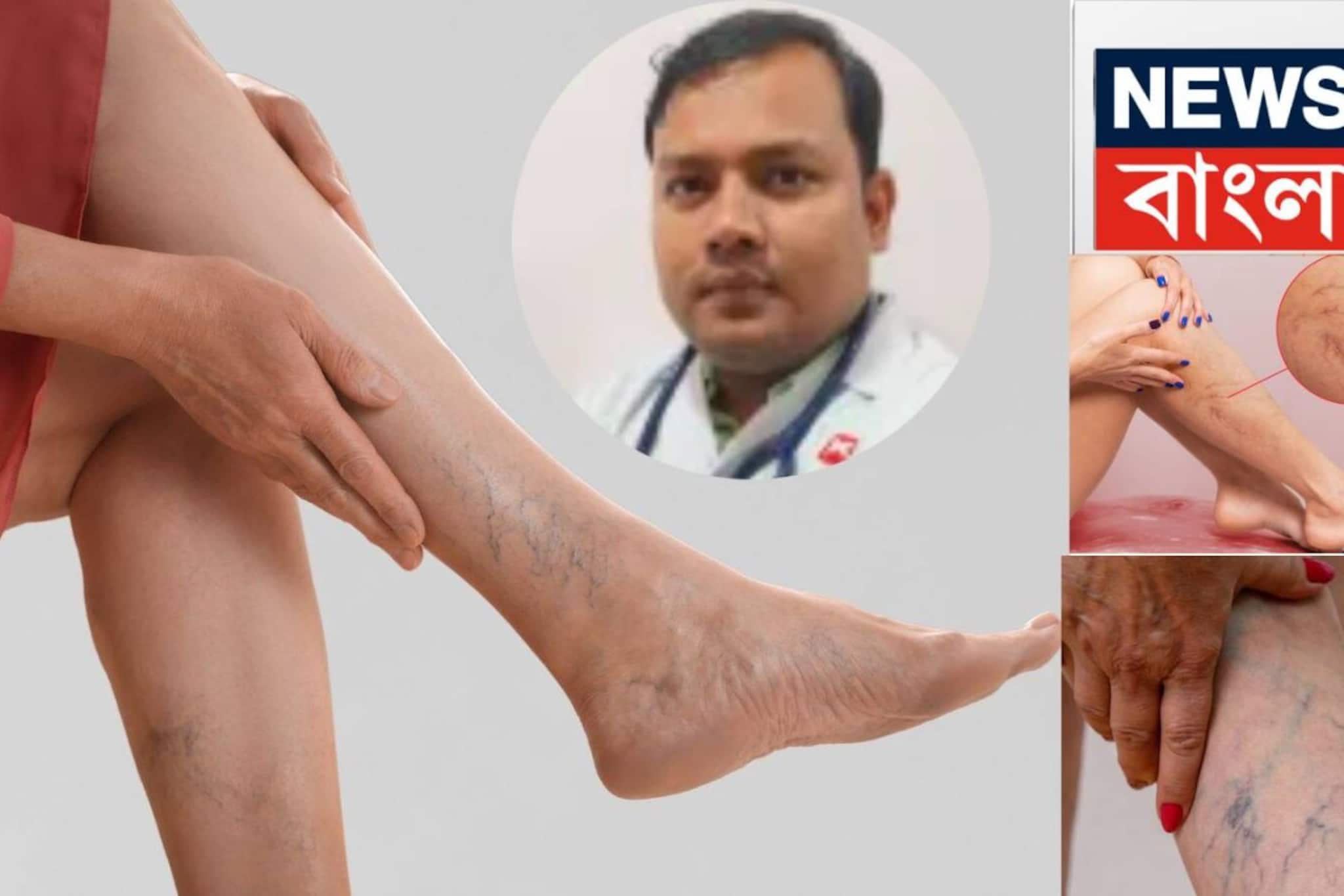 Varicose Veins: পায়ে রক্ত জমাট বেঁধে…কী এই ভ্যারিকোজ ভেইন রোগ? পায়ে ঘায়ের সঙ্গে আর কী কী লক্ষণ ফুটে ওঠে শরীরে? কাদের আক্রান্ত হওয়ার ঝুঁকি বেশি? জানুন