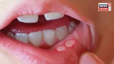 Mouth Ulcer Not Healing in 2 Weeks? Common Sore or Oral Cancer Warning Sign—Recognize Symptoms
