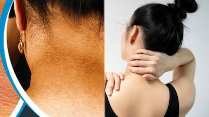 Black Neck Cleaning Tips: শ্যাম্পুতে এই ‘৪’ ঘরোয়া জিনিস মিশিয়ে পরিষ্কার করলেই উধাও ঘাড়ের কালো দাগছোপ! গায়েব জমে থাকা ট্যান ও ময়লা Black Neck Cleaning Tips: শ্যাম্পুতে এই ‘৪’ ঘরোয়া জিনিস মিশিয়ে পরিষ্কার করলেই উধাও ঘাড়ের কালো দাগছোপ! গায়েব জমে থাকা ট্যান ও ময়লা