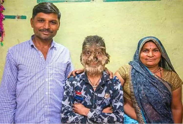 લલિતની મા પર્વતબાઈ કહે છે કે પરિવારમાં 14 લોકો છે. જન્મથી તેના શરીર પર સામાન્ય બાળકો કરતા વધુ વાળ છે. ડૉક્ટરએ કહ્યું હતું કે લલિતને જન્મજાત હાયપરટ્રિકોસિસની બીમારી છે અને તેની સારવાર ઉપલબ્ધ નથી. લલિતની મા પર્વતબાઈ કહે છે કે પરિવારમાં 14 લોકો છે. જન્મથી તેના શરીર પર સામાન્ય બાળકો કરતા વધુ વાળ છે. ડૉક્ટરએ કહ્યું હતું કે લલિતને જન્મજાત હાયપરટ્રિકોસિસની બીમારી છે અને તેની સારવાર ઉપલબ્ધ નથી.