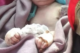 નવજાતનાં હાથમાં હતી 6-6 આંગળીઓ, દાયણે 1-1 કાપી નાંખી, થયું મોત