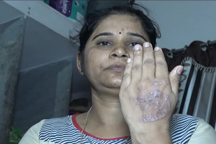 કોરોના વાયરસ (coronavirus) લઇને શહેરની બહારથી આવતા લોકો શહેરમાં પ્રવેશ કરતા તંત્ર દ્વારા ક્વૉરન્ટીનના સિક્કા મારવામાં આવે છે. ત્યારે શહેર બહારથી આવેલા એક પરિવાર તંત્ર દ્વારા ક્વૉરન્ટીનના સિક્કા (Quarantine stamp) માર્યા બાદ પરિવારના ત્રણ સભ્યોને એલર્જીથી ચામડી બળી જતા પરિવાર મૂંઝવણમાં મૂકાયો હોવાની ઘટના સામે આવી છે. જૂનાગઢથી પરત ફર્યા બાદ પરિવાર ક્વૉરન્ટીનમાં છે. (કિર્તેશ પટેલ, સુરત) કોરોના વાયરસ (coronavirus) લઇને શહેરની બહારથી આવતા લોકો શહેરમાં પ્રવેશ કરતા તંત્ર દ્વારા ક્વૉરન્ટીનના સિક્કા મારવામાં આવે છે. ત્યારે શહેર બહારથી આવેલા એક પરિવાર તંત્ર દ્વારા ક્વૉરન્ટીનના સિક્કા (Quarantine stamp) માર્યા બાદ પરિવારના ત્રણ સભ્યોને એલર્જીથી ચામડી બળી જતા પરિવાર મૂંઝવણમાં મૂકાયો હોવાની ઘટના સામે આવી છે. જૂનાગઢથી પરત ફર્યા બાદ પરિવાર ક્વૉરન્ટીનમાં છે. (કિર્તેશ પટેલ, સુરત)