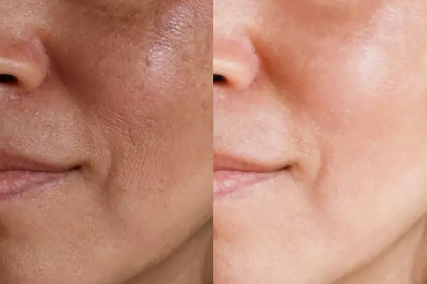સ્વસ્થ અને ચમકીલી ત્વચા (Skin) બધાને જોઈતી હોય છે પરંતુ જો ચહેરાના રોમછિદ્રો ખુલી (Open pores) જાય તો ત્વચાની સુંદરતા ધીરે-ધીરે નષ્ટ થઈ જાય છે. આમ તો ખુલ્લા રોમછિદ્રોની સમસ્યા સામાન્ય છે પરંતુ જ્યારે આ સમસ્યા કોઈને થાય છે તો જલ્દી તેનો પીછો છોડતી નથી, સાથે જ આ સમસ્યાને કારણે સ્કિનની અન્ય સમસ્યાઓ પણ ઉદભવે છે. આ ખુલ્લા રોમછિદ્રોને કારણે ત્વચા અસામાન્ય, બેજાન અને ત્વચામાં ખાડા પડી જાય છે. જેથી આજે આ સમસ્યાને જડથી દૂર કરવાના સરળ ઉપાય જાણી લો. સ્વસ્થ અને ચમકીલી ત્વચા (Skin) બધાને જોઈતી હોય છે પરંતુ જો ચહેરાના રોમછિદ્રો ખુલી (Open pores) જાય તો ત્વચાની સુંદરતા ધીરે-ધીરે નષ્ટ થઈ જાય છે. આમ તો ખુલ્લા રોમછિદ્રોની સમસ્યા સામાન્ય છે પરંતુ જ્યારે આ સમસ્યા કોઈને થાય છે તો જલ્દી તેનો પીછો છોડતી નથી, સાથે જ આ સમસ્યાને કારણે સ્કિનની અન્ય સમસ્યાઓ પણ ઉદભવે છે. આ ખુલ્લા રોમછિદ્રોને કારણે ત્વચા અસામાન્ય, બેજાન અને ત્વચામાં ખાડા પડી જાય છે. જેથી આજે આ સમસ્યાને જડથી દૂર કરવાના સરળ ઉપાય જાણી લો.