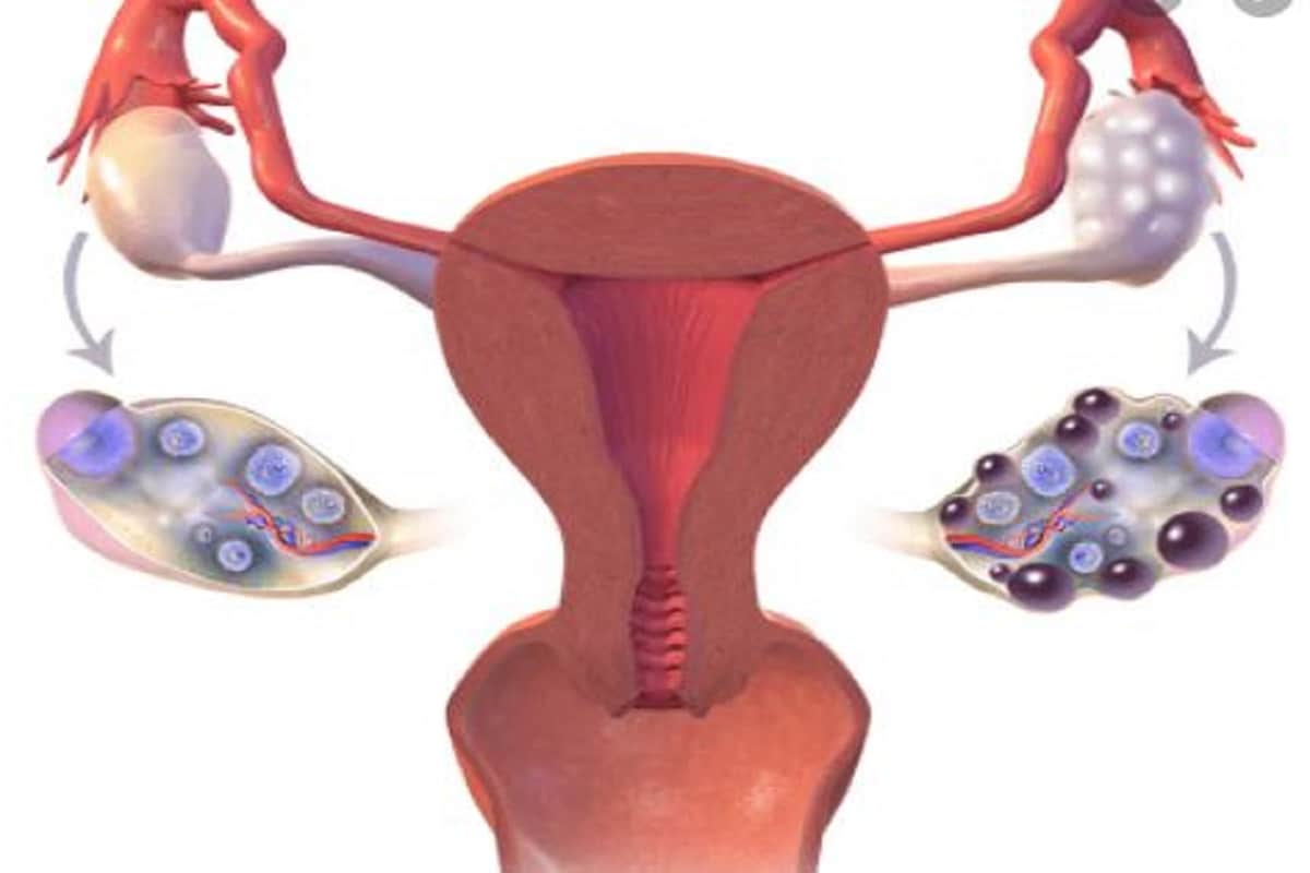 PCOS મોટાભાગે મહિલાઓમાં એન્ડ્રોજન અને પુરુષ હોર્મોનનું ઉચ્ચ સ્તર હોય છે. આ બીમારી મોટે ભાગે આંતરિક સમસ્યાઓ એન્ડ્રોજન વૃદ્ધિની સમસ્યા સાથે જોડાયેલી હોય છે. PCOS મોટાભાગે મહિલાઓમાં એન્ડ્રોજન અને પુરુષ હોર્મોનનું ઉચ્ચ સ્તર હોય છે. આ બીમારી મોટે ભાગે આંતરિક સમસ્યાઓ એન્ડ્રોજન વૃદ્ધિની સમસ્યા સાથે જોડાયેલી હોય છે.