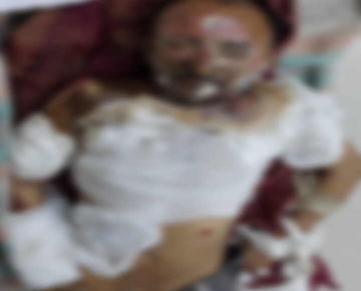 દરમિયાન દારૂના નશામાં છાકટા બનેલા શખ્સો વચ્ચે માથાકૂટ થઈ હશે જેના કારણે દેવીપૂજક પરિવારે અતુલને તાપણમાં ફેંકી દીધો હતો,. તેનું મોઢું પકડી અને તાપણામાં નાખી દેતા તે ભડભડ બળતી આગમાં ગમખ્વાર ઇજાઓ પામ્યો હતો. દરમિયાન દારૂના નશામાં છાકટા બનેલા શખ્સો વચ્ચે માથાકૂટ થઈ હશે જેના કારણે દેવીપૂજક પરિવારે અતુલને તાપણમાં ફેંકી દીધો હતો,. તેનું મોઢું પકડી અને તાપણામાં નાખી દેતા તે ભડભડ બળતી આગમાં ગમખ્વાર ઇજાઓ પામ્યો હતો.