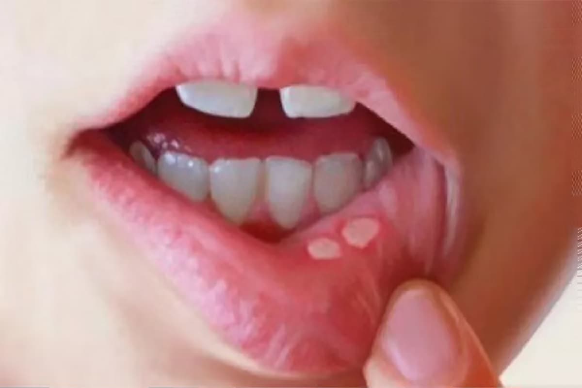 મોંમા ચાંદા પડવાની (Mouth ulcer) સમસ્યા સામાન્ય છે પરંતુ આ થાય ત્યારે ઘણી જ તકલીફ પહોંચે છે. મોંમાં ચાંદા પડવાને કારણે તે જગ્યાએ કંઇ પણ જમવાનું કે પાણી પણ જાય તો બહુ બળે છે. હોર્મોનમાં ફેરફાર, વધારે પડતી એસિડીટી (Acidity), હર્પીસ વાઈરસ ઈન્ફેક્શન, મોંમાં ઈજા, જીભ કે અંદરનો ગાલ ચવાઈ ગયો હોય તો, સ્ટ્રેસ, વારસાગત કારણોસર, વિટામિન બીની કમી, અપચો, મોં આવી જવુ આ બધાને કારણે મોંમા ચાંદા પડી જાય છે. આની સારવાર માટે ઘરગથ્થુ ઉપચાર (home made remedy) જોઇએ જે આપણે વર્ષોથી વાપરતા આવીએ છીએ, આવા કેટલાક દાદીમાનાં ઉપાયો આજે જાણીએ. મોંમા ચાંદા પડવાની (Mouth ulcer) સમસ્યા સામાન્ય છે પરંતુ આ થાય ત્યારે ઘણી જ તકલીફ પહોંચે છે. મોંમાં ચાંદા પડવાને કારણે તે જગ્યાએ કંઇ પણ જમવાનું કે પાણી પણ જાય તો બહુ બળે છે. હોર્મોનમાં ફેરફાર, વધારે પડતી એસિડીટી (Acidity), હર્પીસ વાઈરસ ઈન્ફેક્શન, મોંમાં ઈજા, જીભ કે અંદરનો ગાલ ચવાઈ ગયો હોય તો, સ્ટ્રેસ, વારસાગત કારણોસર, વિટામિન બીની કમી, અપચો, મોં આવી જવુ આ બધાને કારણે મોંમા ચાંદા પડી જાય છે. આની સારવાર માટે ઘરગથ્થુ ઉપચાર (home made remedy) જોઇએ જે આપણે વર્ષોથી વાપરતા આવીએ છીએ, આવા કેટલાક દાદીમાનાં ઉપાયો આજે જાણીએ.