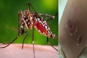 ઓસ્ટ્રેલિયામાં જોવા મળી એક ભયંકર બિમારી, ડોક્ટરોએ વ્યક્ત કરી ચિંતા