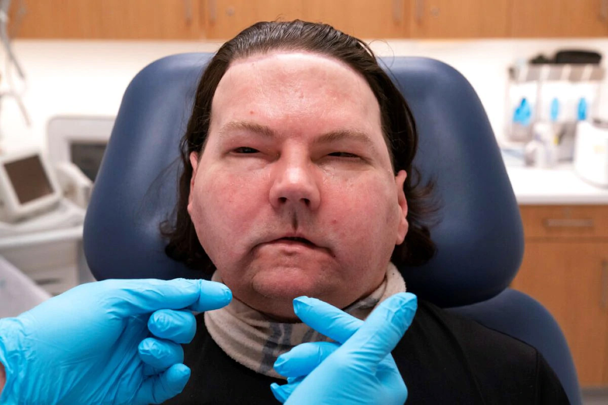  ન્યૂ યોર્કઃ પોતાના પડકારરૂપ ફેસ (Face Transplant) અને હેન્ડ ટ્રાન્સપ્લાન્ટ (Hand Transplant)ના લગભગ 6 મહિના બાદ જો ડીમિયો (Joe Dimeo) હવે ફરીથી હસતા, આંખોને બંધ-બોલતા, છીંકતા અને ચૂંટણી ભરતા શીખી રહ્યો છે. અમેરિકા (America)ના રહેવાસી 22 વર્ષીય જો ડીમીયોનું આ ખૂબ જ અઘરું ઓપરેશન ઓગસ્ટ 2020માં કરવામાં આવ્યું હતું. એક કાર અકસ્માતમાં તેનો ચહેરો ખૂબ ગંભીર રીતે બળી ગયો હતો. (Photo- AP)