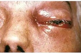 સૌરાષ્ટ્રમાં મ્યુકરમાઇકોસીસનાં અંદાજીત 659 કેસ સામે આવ્યા, રાજકોટમાં 77 દર્દી સારવાર હેઠળ