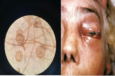 mucormycosis All information mucormycosis symptoms mucormycosis treatment  mucormycosis Cost of treatment mucormycosis patient– News18 Gujarati