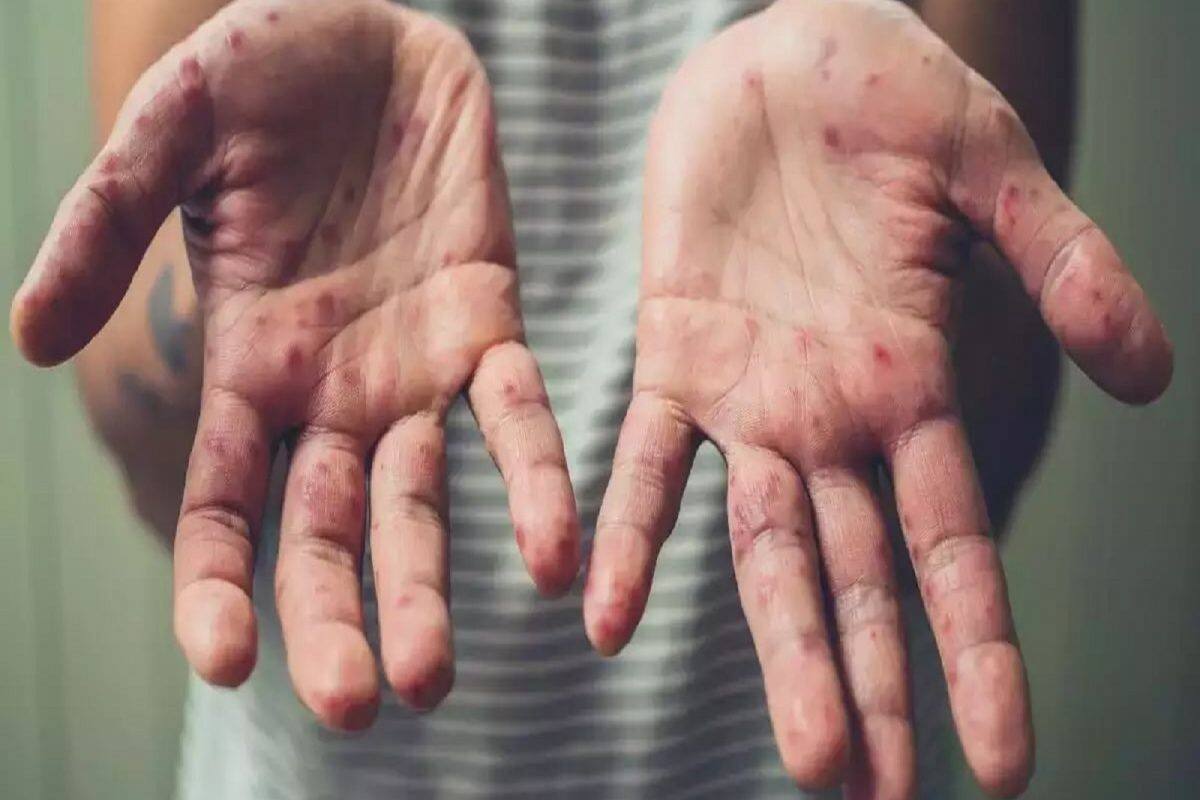 Monkeypox Cases: ભારત પર મંકીપોક્સનું કેટલું જોખમ, શું છે સરકારની તૈયારીઓ? જાણો બધી જ વિગતો