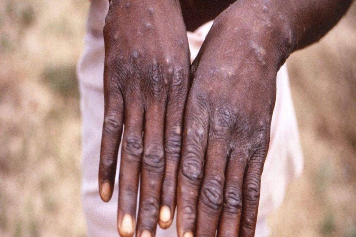 Monkeypox: શું મંકીપોક્સ એઇડ્સ જેવો જાતીય રોગ છે? જાણો શું કહે છે મેડિકલ એક્સપર્ટ્સ
