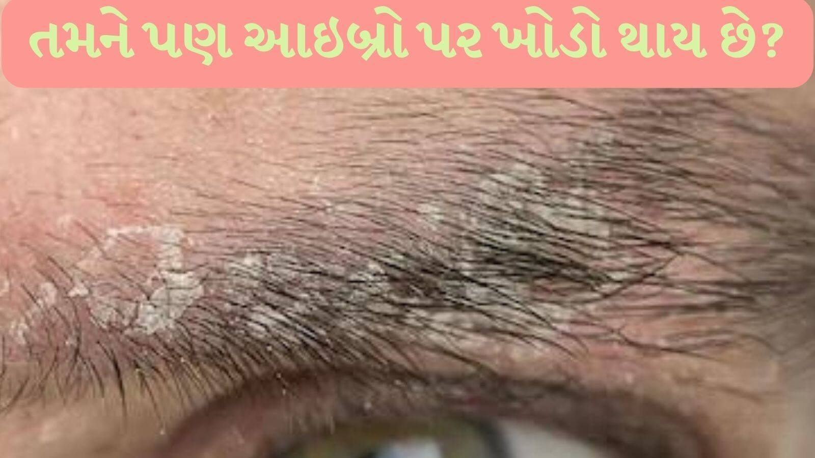 follow these home remedies and remove dandruff in eyebrows આઇબ્રો પર