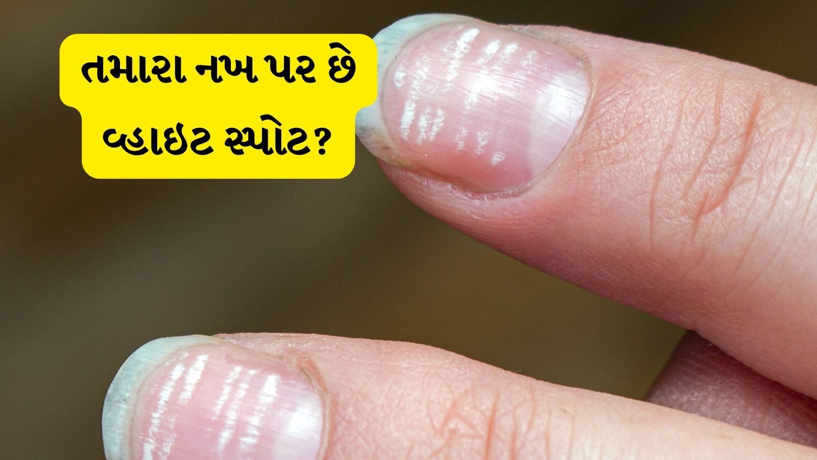 know-white-spots-on-nails-and-be-care