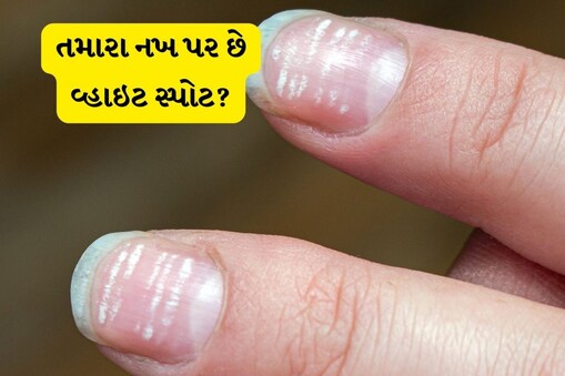 know White Spots on Nails and be care - નખ પર વ્હાઇટ સ્પોટ હોય તો ખાસ વાંચી લો આ આર્ટિકલ – News18 Gujarati know White Spots on Nails and be care - નખ પર વ્હાઇટ સ્પોટ હોય તો ખાસ વાંચી લો આ આર્ટિકલ – News18 Gujarati