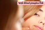 શું તમે જાણો છો Blind pimples વિશે?