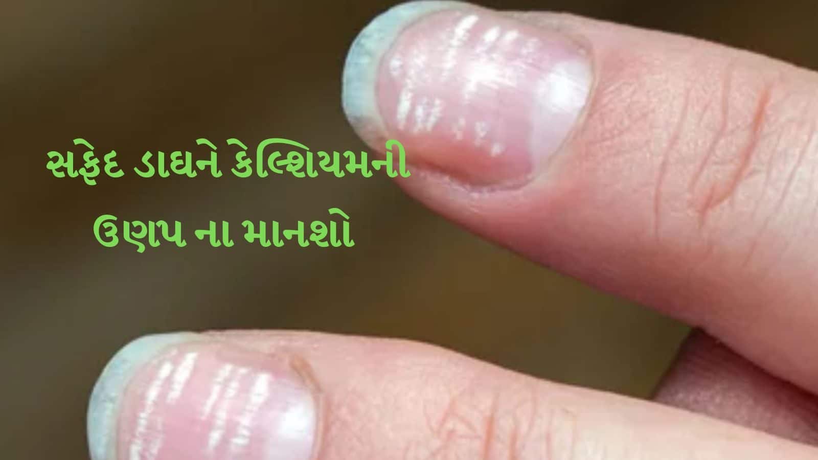 Nail white spots know more what is problems તમારા નખમાં વ્હાઇટ નિશાન