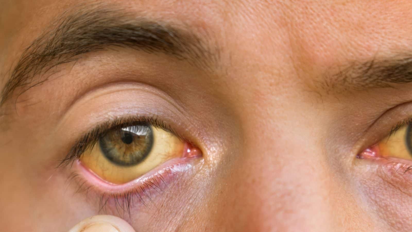 Best drink to jaundice after good health કમળો થાય ત્યારે પીઓ આ જ્યૂસ News18 Gujarati