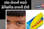 Fevikwik Treatment: ડોકટરે 7 વર્ષના બાળકના ઘા પર ટાંકા લેવાને બદલે ફેવી ક્વીક લગાવી દીધી