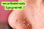 માત્ર 10 દિવસમાં ફેસ પરથી વ્હાઇટ હેડ્સ દૂર કરો..આ ઉપાય છે અસરકારક