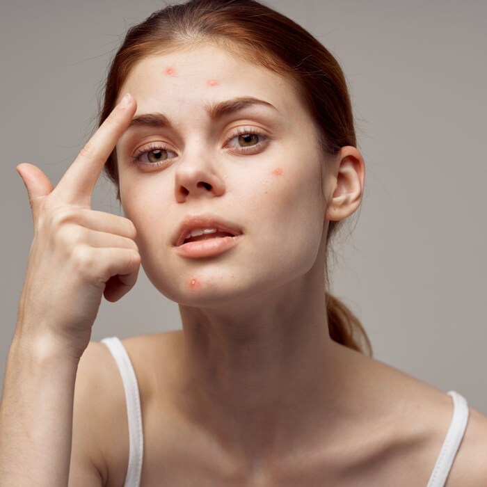 How to get rid of pimples before Diwali દિવાળી પહેલાં આ વસ્તુ ચહેરા