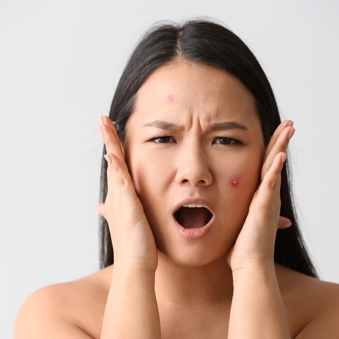 How to get rid of pimples before Diwali દિવાળી પહેલાં આ વસ્તુ ચહેરા