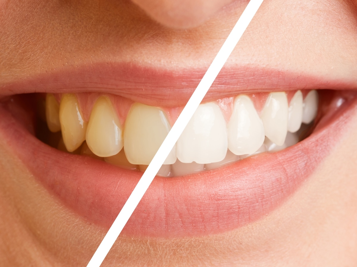 how to remove yellow stains from teeth - પીળા દાંત 1 જ દિવસમાં મોતી જેવા  સફેદ થઇ જશે, આ ઘરેલુ નુસ્ખાખી ચમકશે બત્રીસી
