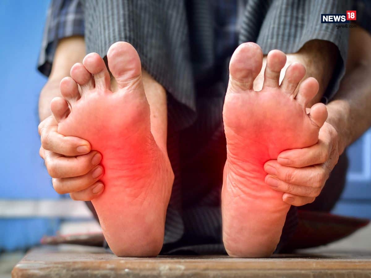 Burning feet syndrome is caused by the deficiency of vitamin b12 આ