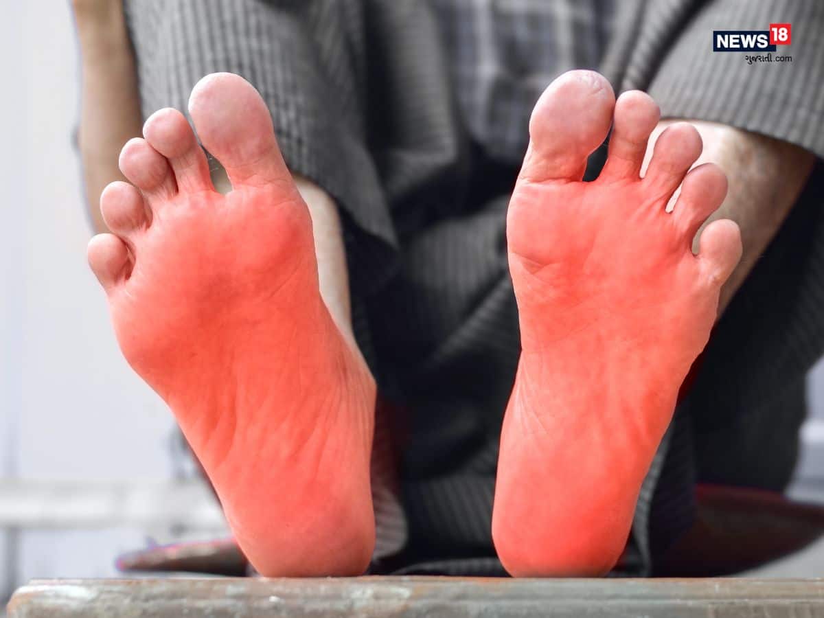 Burning feet syndrome is caused by the deficiency of vitamin b12 આ