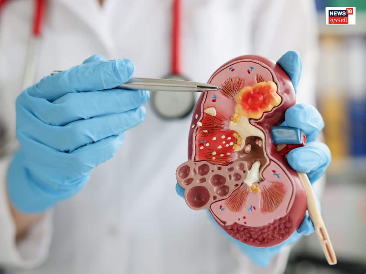 કિડનીમાં પથરીની સમસ્યાથી છો પરેશાન? આયુર્વેદિક ડૉક્ટરની આ સલાહ માનશો તો