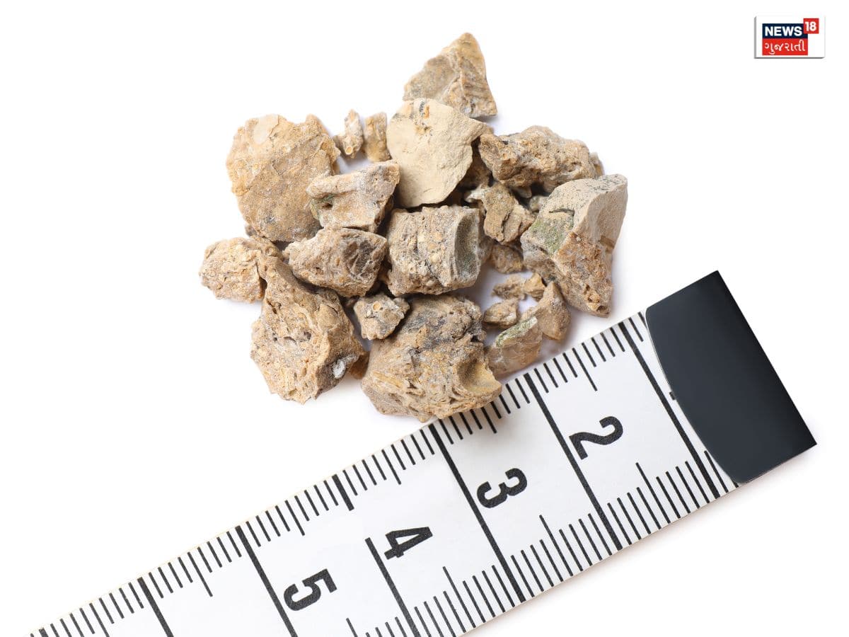 કિડનીમાં પથરીની સમસ્યાથી છો પરેશાન? આયુર્વેદિક ડૉક્ટરની આ સલાહ માનશો તો