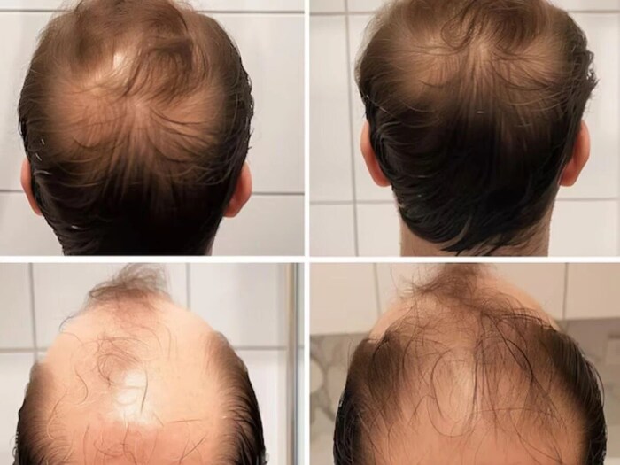 According to experts at the American Academy of Dermatology, each person loses an average of 50-100 hairs per day. The number may seem large. But we have more or less 100,000 hair follicles on our head and hair grows back. But it is a matter of concern when the hair falls excessively. Hair becomes thinner. Baldness appears on the head.