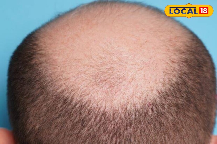 Hair loss has become a common problem, which everyone feels uncomfortable, as soon as the hair starts to fall from your head, you start to be afraid of falling, because of this fear you take expensive medicine, but still do not diminish the hair, if your hair is completely reduced, you can grow them again.