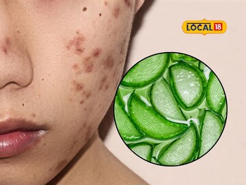 Home remedy to cure pimples