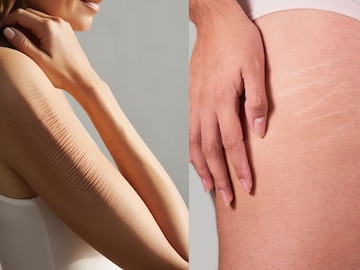 Stretch Marks on the body? Massage this thing by applying it; Within a few days, the results will be resolved Stretch Marks on the body? Massage this thing by applying it; Within a few days, the results will be resolved