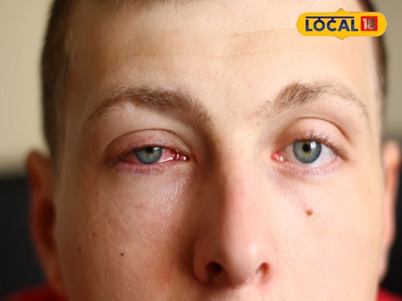     Many people make the mistake of rubbing the eyes during these symptoms, which increases the problem. If you have itching, irritation or screaming in the eyes, first wash your eyes with clean water. Then, avoid rubbing the eyes frequently. Use dark -colored glasses on the eyes when you go into the eyes, so that the fluid in the eyes and reduces the effect of the infection.