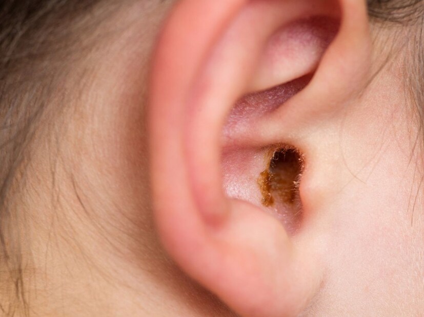     Do not mistake in the ears- According to the doctor, ghee, oil, garlic oil should never be added to the ear to clean the ear. This can cause fungal infections in the ear. In addition, water, ear candles should not be used in the ears. The ear should not be laid in the ear, hair clip, matchstick etc. This is why the wax is likely to go inside the ear.