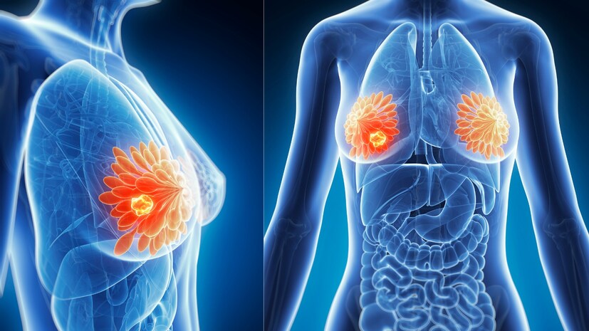 Symptoms of Breast Cancer