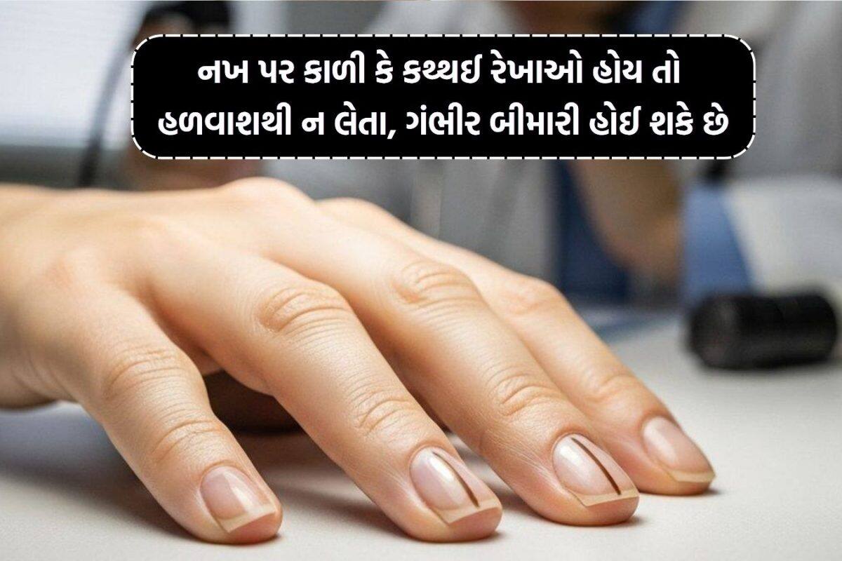 Brown Line on Nails: નખ પર કાળી કે કથ્થઈ રેખાઓ છે? તો હળવાશથી ન લેતા, ગંભીર બીમારી હોઈ શકે છે