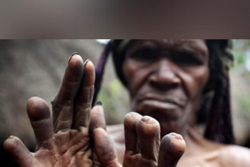 جی ہاں، آپ نے اسے صحیح پڑھا۔ انڈونیشیا (Indonesia)  کا ایک قبیلہ ایسا ہے جن کی عورتیں اپنی انگلیاں  (Women cut off fingers)  کاٹ دیتی ہیں۔ دنیا بھر کے مختلف معاشروں میں خواتین کو رسم و رواج کے نام پر بہت سے مسائل اور مشکلات کا سامنا کرنا پڑتا ہے ۔