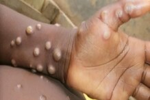 جنسی رویے کو درست کریں، گلے ملنا، کسنگ کم ہو،Monkeypox پر WHO کی گائیڈ لائن