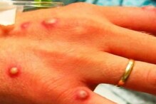 ہندستان میں پائے جانے والے 4 میں سے 3 کیسز میں Monkeypox جسمانی تعلقات سے پھیلا: ذرائع
