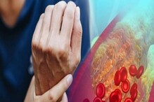 High Cholesterol Signs:ہاتھوں میں نظر آئی ایسی علامات تو فوری ڈاکٹر سے کریں رابطہ